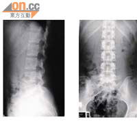 接受融合術前，X光片顯示Doris的腰椎情況。