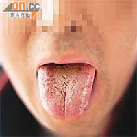 有「陰滋病」患者舌苔長出絨毛。