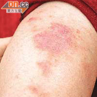濕疹患者病發時，皮膚出現紅腫及痕癢徵狀，影響日常生活。
