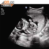 胎盤偏側<br>胎盤位置偏側的孕婦自然早產的風險高約一倍。