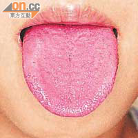 舌頭出現士多啤梨舌的紅腫情況是猩紅熱的主要病徵。