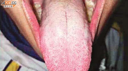 舌象：舌紅，舌尖尤甚，舌態活動自如，苔白膩而濕潤滑利。