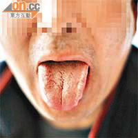「陰滋病」病毒至今仍謎團未解，患者會舌苔生絨毛症狀。