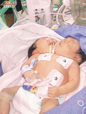 新橋醫院透過電腦斷層掃描，發現雙頭女嬰擁有兩個胃。