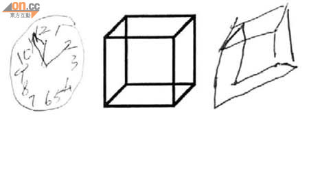 圖左：患病裁縫無法正確畫出「十時十分」的時鐘鐘面；圖中及右：亦無法依樣畫出立方體。	（《香港醫學雜誌》圖片）