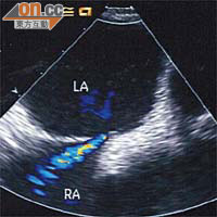 從超聲波可見血液及血栓（藍色部分）由右心房流向左心房。