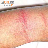 猩紅熱患者皮膚會出現紅疹。	（資料圖片）