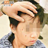 報稱被同學打傷的男生臉部及眼角有傷痕。	（許錦雄攝）