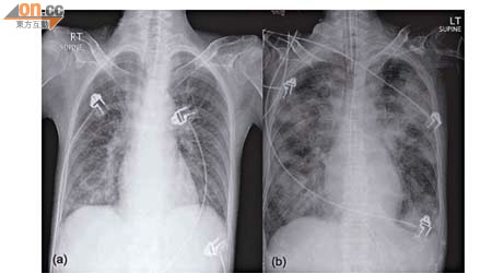 X光顯示患者入院時（左）肺部仍算「清澈」，但轉入深切治療部時（右）已有嚴重肺浸潤，顯示肺部受損。（《香港急症醫學期刊》圖片）