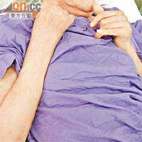 病人腋下及手肘內側因痙攣屈曲，難以清洗。
