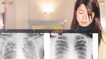 本港肺癆個案近年銳減，但防控工作不可鬆懈。	（資料圖片）