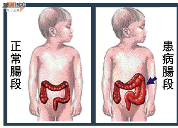 「先天性巨結腸症」的圖片搜尋結果