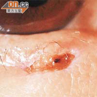 港人常患基底細胞癌，是眼皮癌其中一種。患者的眼皮會突出一粒似痣的腫瘤。	（黃澤銘醫生提供圖片）