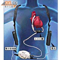 人工心臟如血液泵，取代左心室的泵血功能，將血液經主動脈運送到全身，另經皮下導線連接電子控制器及體內裝置，病人要佩戴電池及電子控制器的袋子。
