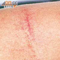 猩紅熱患者皮膚出現紅疹。
