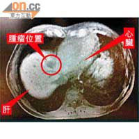 掃描圖片顯示該名大腸癌肝轉移的男病人的腫瘤，位於肝頂近心臟的敏感位置，不宜開刀。