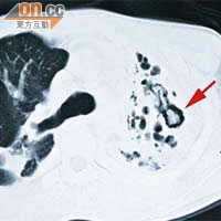 電腦掃描顯示，真菌在游先生左上肺長出真菌球（箭嘴示）。