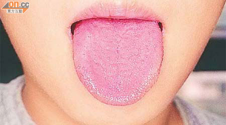 猩紅熱主要病徵為草莓舌、沙紙樣紅疹、發燒及喉嚨痛。