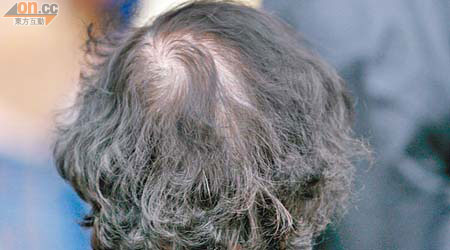 女性失婚喪偶，容易導致脫髮。（資料圖片）