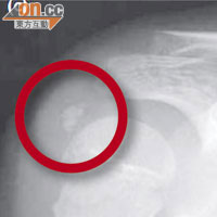 服藥前<br>Ｘ光顯示七歲男童的右肩肱骨外側有一粒磷酸鈣結晶（紅圈示），引發肌腱炎。（《香港醫學雜誌》圖片）