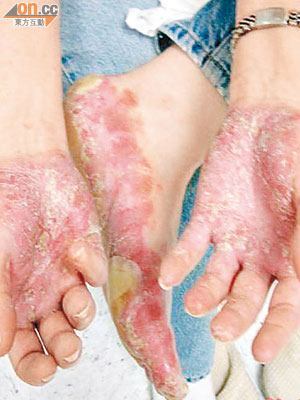 牛皮癬攻擊人體皮膚及指甲等位置。