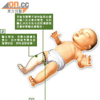 初生男嬰截肢過程