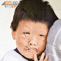 刊於《東快訊》面部燒傷小童求助報道的照片。