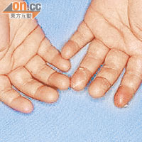 川崎症多發生於一歲以下幼童身上，患者雙手紅腫及脫皮。