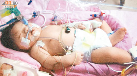 出世時腦部缺氧的歐家ＢＢ在新生嬰兒深切治療部插滿喉管治療。