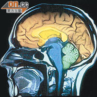 腦癇主要成因是腦損傷。