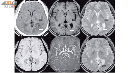 男病人的電腦掃描及磁力共振影像顯示其左腦中風（箭嘴示）。（圖片由《香港醫學雜誌》提供）