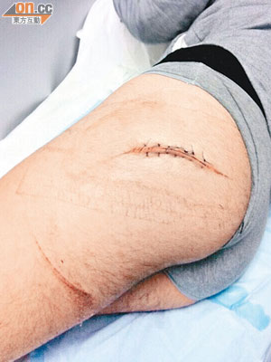 受傷男生臀部留下一條約一呎長傷痕。
