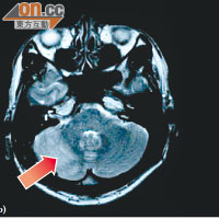 磁力共振圖片顯示，患者的小腦呈淺白色部分（箭嘴示），代表有發炎徵狀。（《香港急症醫學期刊》提供）