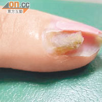 十八歲少女因長期美甲，食指指甲發炎蝕掉，造甲細胞遭破壞。