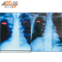 李先生確診前，X光片顯示肺部有白色斑點（左圖）。服食標靶藥後，斑點明顯減少（右圖）。