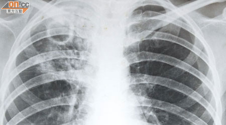 肺癆菌會經呼吸道侵入病者肺部。（何天成攝）