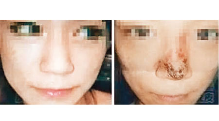 台灣女子經注射後鼻子流膿變黑。（電視畫面）
