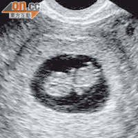 九周大胎兒超聲波照