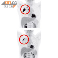 上圖：患者治療前，右胸出現陰影，顯示肺腺癌細胞擴散至胸椎。<br>下圖：經標靶藥配合化療後，患者右胸的癌細胞縮小。