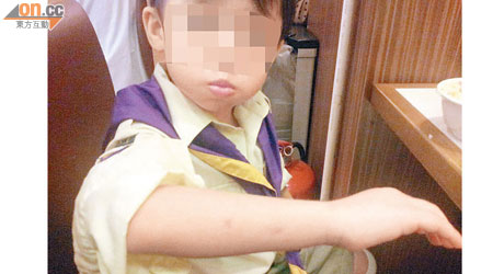 男童上月中放學後，家長在其前臂發現兩處瘀痕。