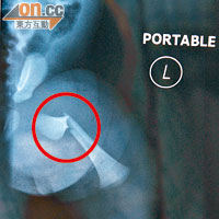Ｘ光片顯示，仁凱左大腿呈螺旋形骨折（紅圈示）。