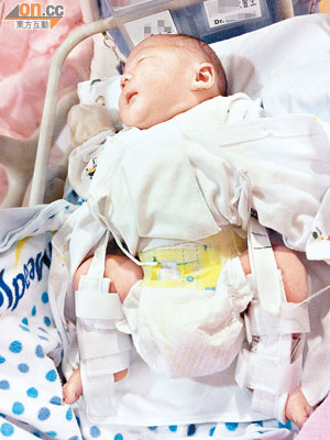 剛出生的仁凱左大腿骨折，需戴上支架及矯形背帶。