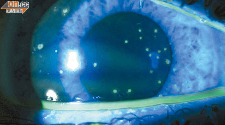 寄生蟲入眼患者角膜及結膜位置滿布白點。