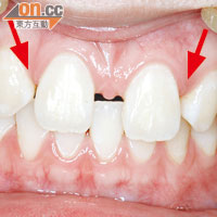 病人上排左右兩隻側門牙缺失（如箭嘴所示），門牙間的牙縫較闊。