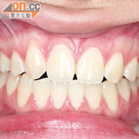 矯齒後，牙醫利用補牙技術填補犬齒，使齒形類似側門牙。