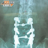 一名女文員因踩背按摩，導致三節腰椎移位，要鑲金屬支架固定。