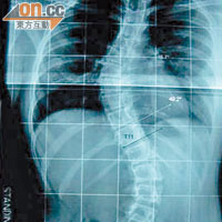 X光片顯示，脊骨側彎患者的脊骨呈「S」形。（被訪者提供）