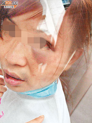 被虐婦人遭丈夫打至口腫面腫，在警車上仍一臉驚恐。（李子強攝）