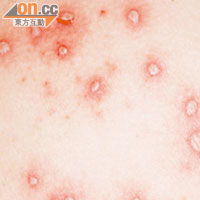 感染水痘可誘發腦炎及肝炎等併發症。