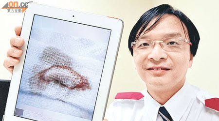 何志偉隨身攜帶iPad為覆診病人評估傷口滲液。